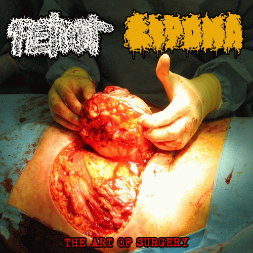 Lipoma : The Art of Surgery